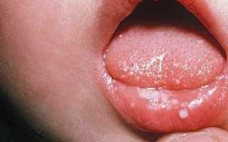 Грамотное лечение стоматита у детей: рекомендации, препараты, народные средства