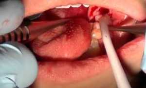 Важно знать! Удаление сложных зубов у лиц с сопутствующими заболеваниями: особенности, степени сложности