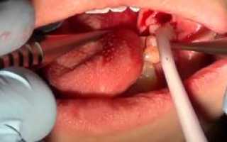 Важно знать! Удаление сложных зубов у лиц с сопутствующими заболеваниями: особенности, степени сложности