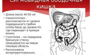 Что такое бластома сигмовидной кишки?