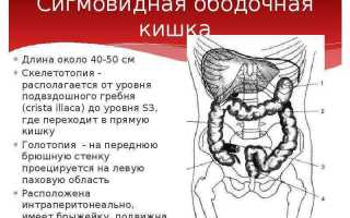 Что такое бластома сигмовидной кишки?