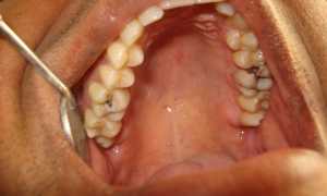 Чем опасен кариес: осложнения заболевания