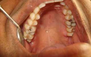 Чем опасен кариес: осложнения заболевания
