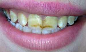 Опасный фтор: причины развития флюороза зубов