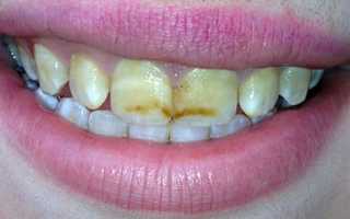 Опасный фтор: причины развития флюороза зубов