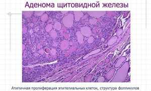 Симптомы и лечение папиллярной аденомы щитовидки