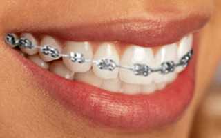 Металлические брекеты – классический вариант ортодонтического лечения