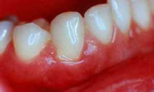 Характеристики детского пародонтита: этиология, симптомы, методы лечения