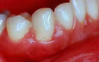 Характеристики детского пародонтита: этиология, симптомы, методы лечения