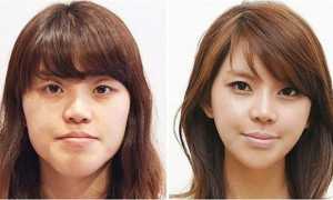 Хирургическое лечение неправильного прикуса