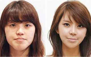 Хирургическое лечение неправильного прикуса