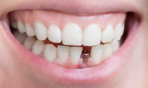 Вернет все утраченные зубы на место! Имплантация: что это такое