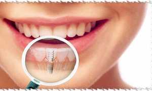 Боль и отечность после установки импланта зуба