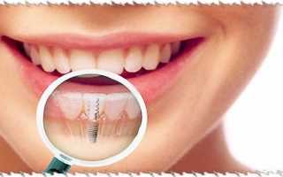 Боль и отечность после установки импланта зуба