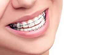 Широкий выбор ортодонтических устройств на любой вкус! Современные виды брекетов и их отличия