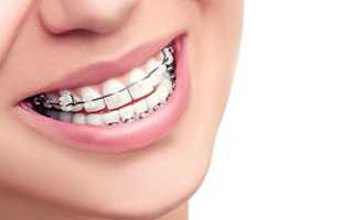Широкий выбор ортодонтических устройств на любой вкус! Современные виды брекетов и их отличия
