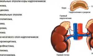 Опухоль надпочечников и способы лечения
