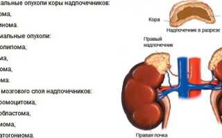 Опухоль надпочечников и способы лечения