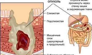 Признаки рака толстой кишки и способы лечения