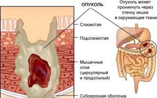 Признаки рака толстой кишки и способы лечения