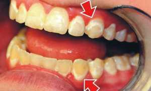 Кариес передних зубов