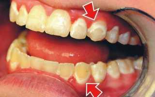 Кариес передних зубов