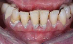 Нужно срочно бежать и лечить! Пародонтоз: что это такое, чем он опасен