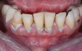 Нужно срочно бежать и лечить! Пародонтоз: что это такое, чем он опасен