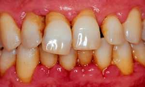 Средства от пародонтита