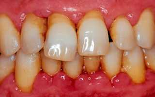 Средства от пародонтита