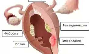 Фиброма матки: её симптомы и лечение