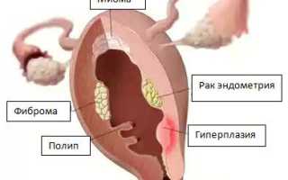 Фиброма матки: её симптомы и лечение