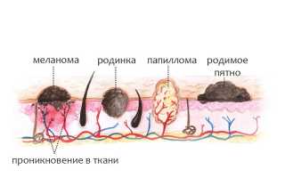 Меланома матки, влагалища и вульвы