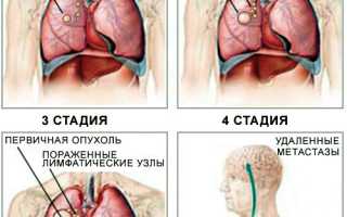 Каковы прогнозы жизни при раке 4 стадии?