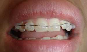 Могут ли они навредить? Негативные последствия ношения брекетов