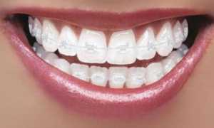 Сапфировые брекеты: особенности, цена, преимущества и недостатки