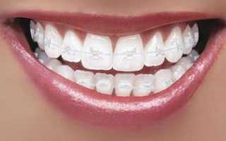 Сапфировые брекеты: особенности, цена, преимущества и недостатки