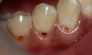 Пришеечный кариес: причины, стадии, лечение, профилактика