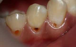 Пришеечный кариес: причины, стадии, лечение, профилактика