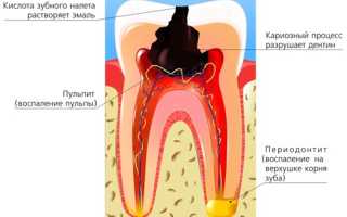 Апикальный периодонтит: этиология, клиника, диагностика и лечение