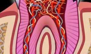 Хронический фиброзный пульпит: симптомы, причины, диагностика, лечение и профилактика