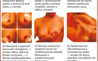 Рак молочной железы: диагностика, симптомы, лечение