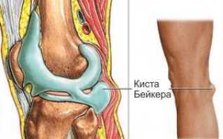 Гигрома Бейкера у детей. Удалять ли?