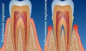 Причины развития пародонтоза