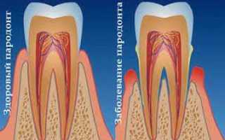 Причины развития пародонтоза