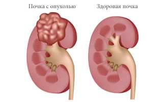 Опухоль почки: симптомы и лечение