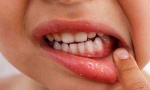 Любая болезнь представляет опасность! Стоматит у ребенка: как лечить и примеры фото