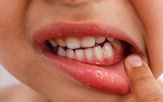 Любая болезнь представляет опасность! Стоматит у ребенка: как лечить и примеры фото