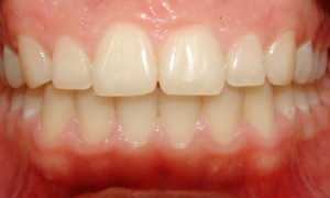 Отличительные особенности глубокого прикуса