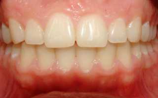 Отличительные особенности глубокого прикуса